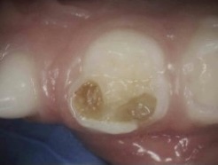 Cavity in tooth